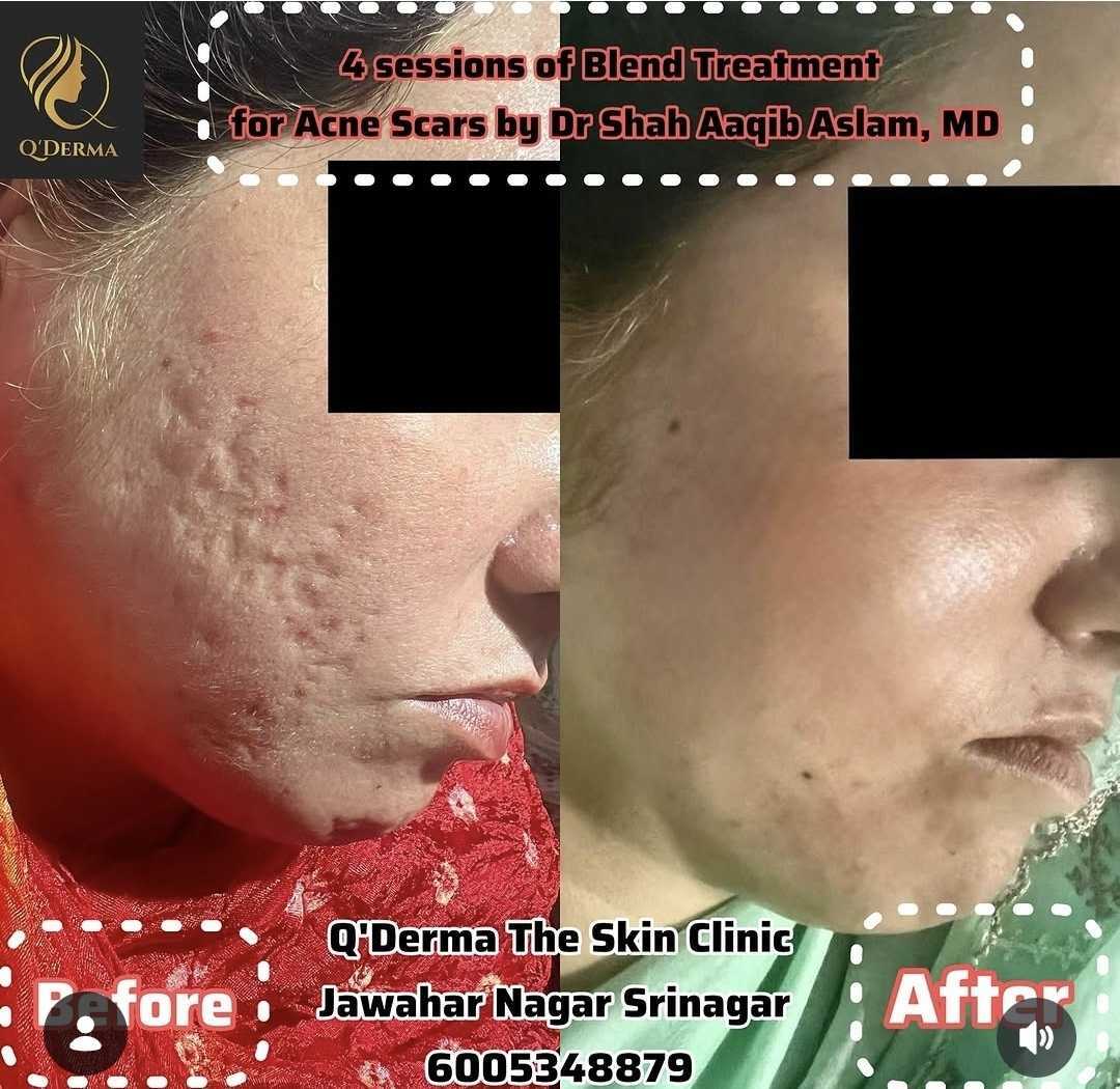 Acne Scar Revision — before and after at Q'DERMA