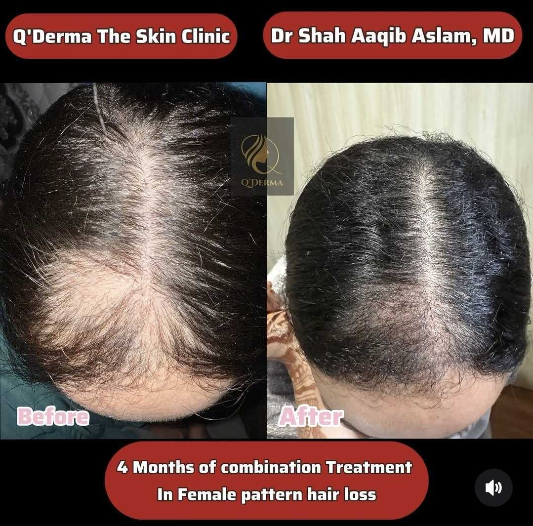 Female Pattern Hair Loss — before and after at Q'DERMA