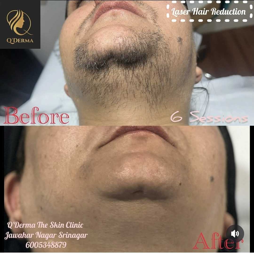Laser Hair Reduction — before and after at Q'DERMA