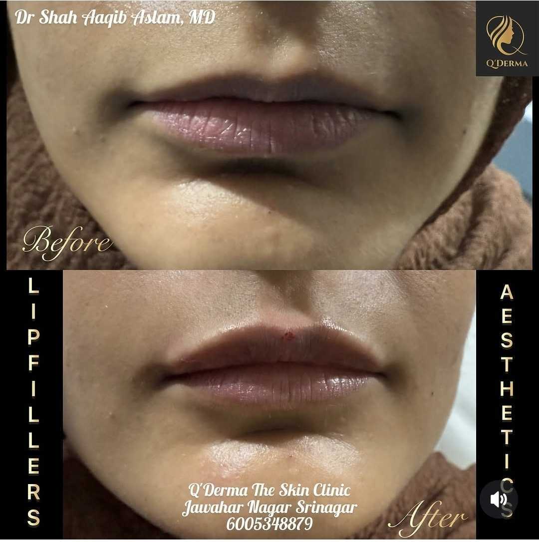 Lip Fillers — before and after at Q'DERMA